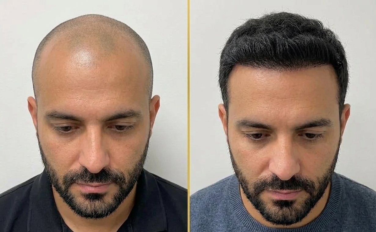 Antes e Depois - Rodrigo Silva